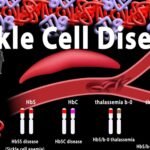 SICKLE CELL