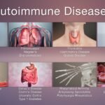 Autoimmune Diseases.