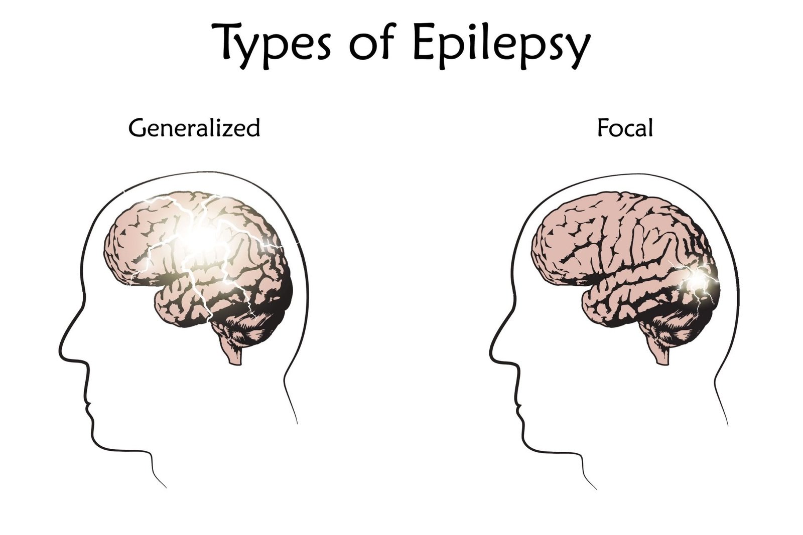 epileptic seizures.